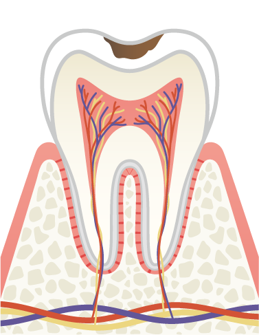 岩手県盛岡市の歯医者・インプラント歯科「高橋衛歯科医院」|C1 エナメル質の虫歯のイメージ