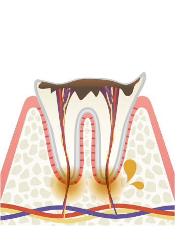 岩手県盛岡市の歯医者・インプラント歯科「高橋衛歯科医院」|C4 歯が溶けて歯根だけ残った歯のイメージ