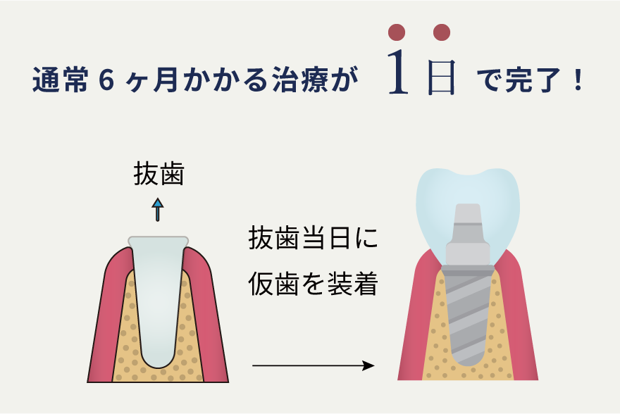 岩手県盛岡市の歯医者・インプラント歯科「高橋衛歯科医院」|抜歯即時埋入インプラントのイメージ