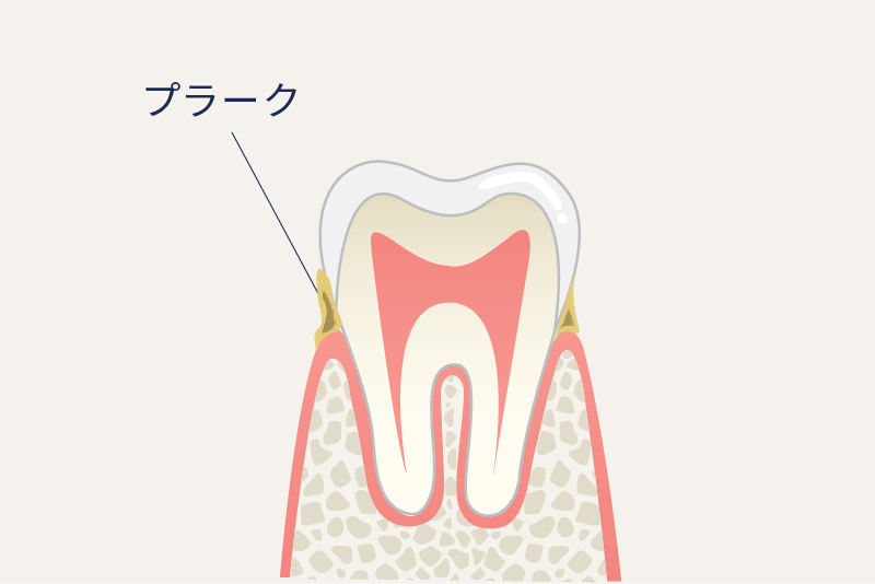 岩手県盛岡市の歯医者・インプラント歯科「高橋衛歯科医院」|保険の白い被せ物の汚れの付着イメージ