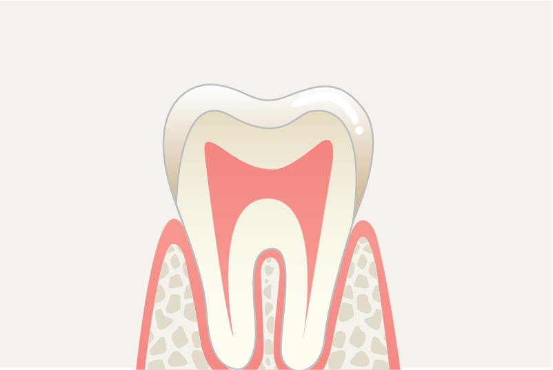 岩手県盛岡市の歯医者・インプラント歯科「高橋衛歯科医院」|保険の白い被せ物の経年劣化や色のイメージ