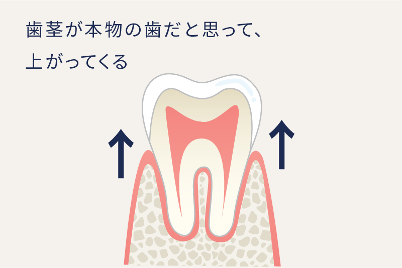 岩手県盛岡市の歯医者・インプラント歯科「高橋衛歯科医院」|自費のジルコニアクラウンの生体親和性イメージ