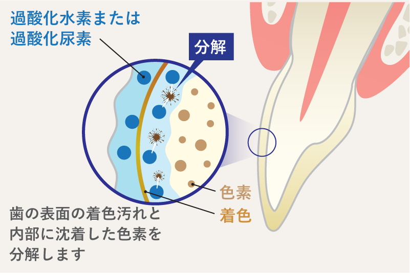 岩手県盛岡市の歯医者・インプラント歯科「高橋衛歯科医院」|医療ホワイトニングでは歯の表面と内部の色素を分解できるイメージ