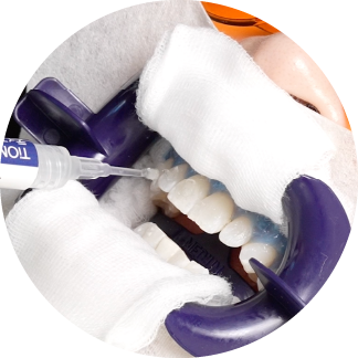 岩手県盛岡市の歯医者・インプラント歯科「高橋衛歯科医院」|歯の表面に医療機関用のホワイトニングの薬剤を塗布するイメージ