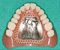 コバルトクロム床義歯